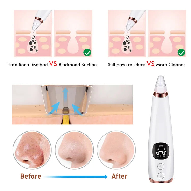 Electric Blackhead Remover